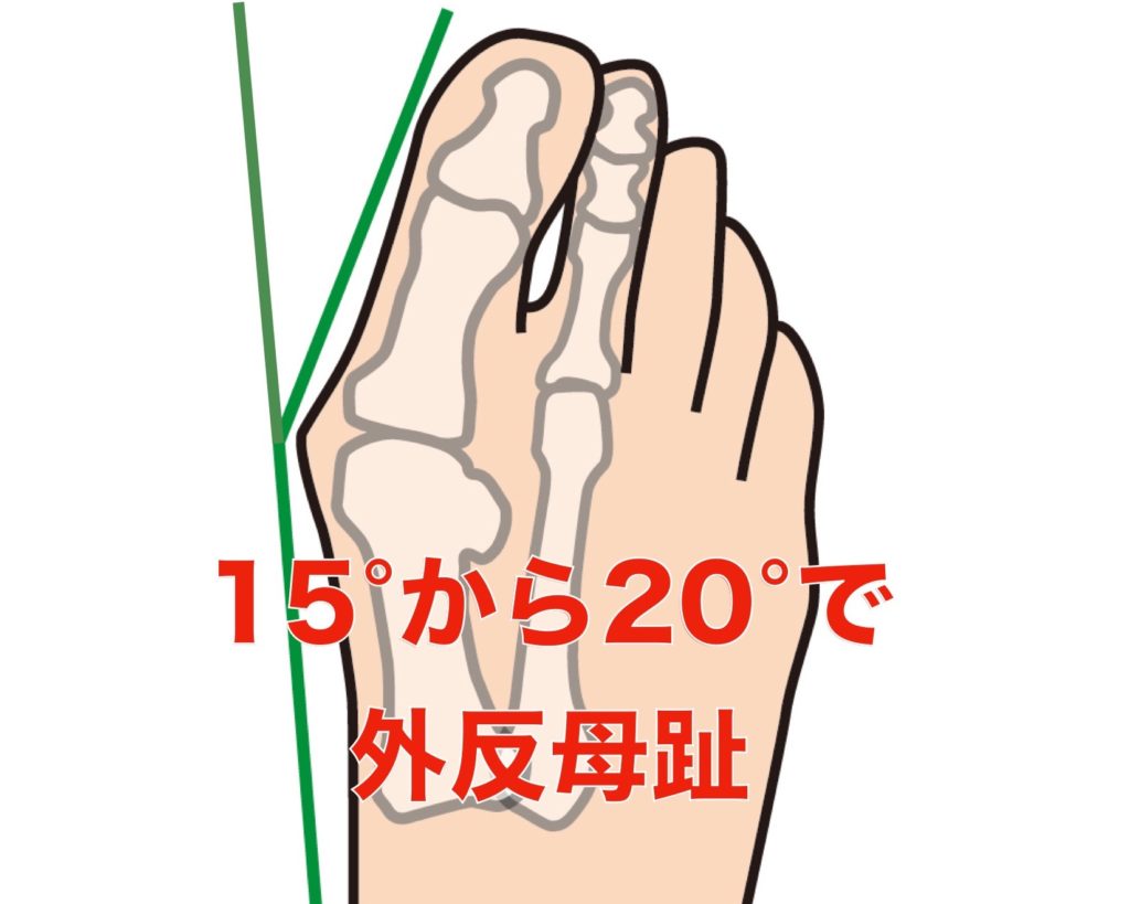 親指の付け根が痛い 外反母趾になる原因と１日３分で痛みを取る方法 Uenishiうえにし整体院 大阪本町の骨盤矯正 猫背姿勢改善整体