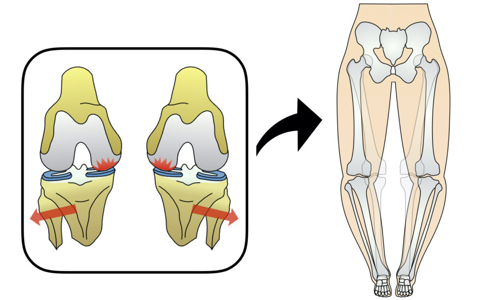 膝軟骨のすり減りと足の変形