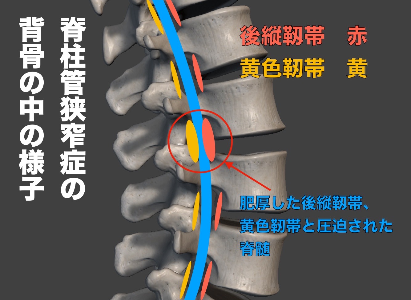 脊柱管狭窄症の背骨