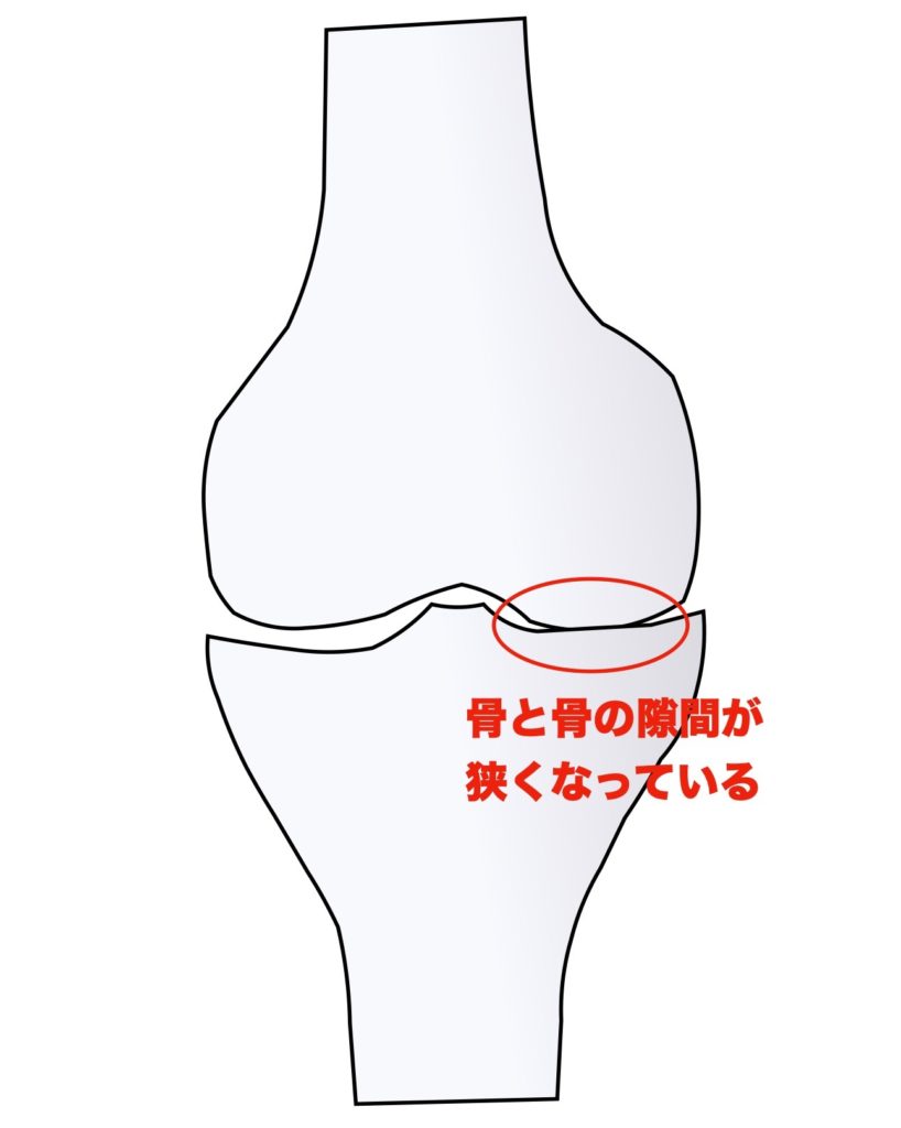 変形性膝関節症のステージ１
