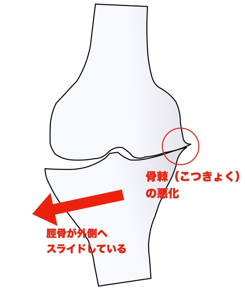 変形性膝関節症のステージ３