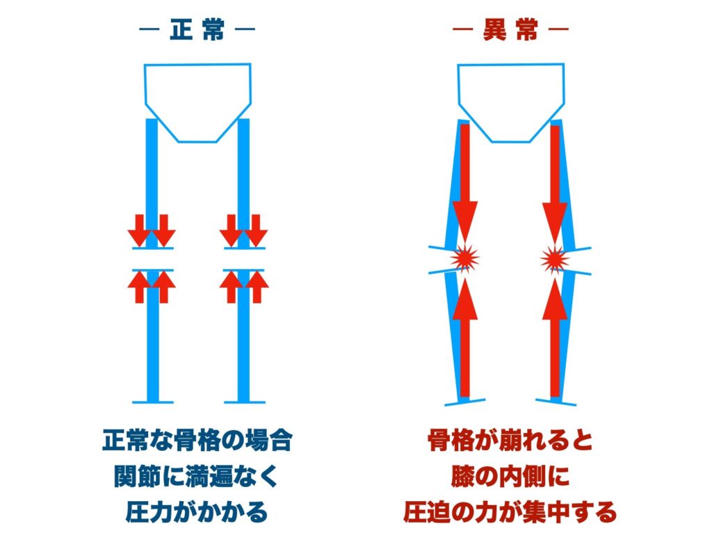 膝関節内側痛の原理